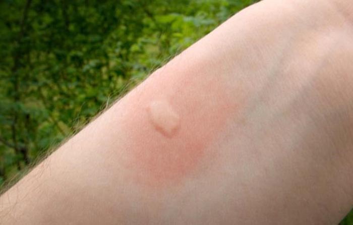 Mosquito vs bed bug Bites