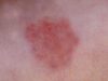 Bed Bug Rash on Skin, Pictures, Treatment, Allergy & Symptoms Bed bug rash