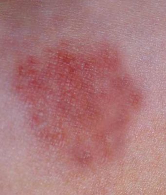 Bed Bug Rash on Skin, Pictures, Treatment, Allergy & Symptoms Bed bug rash