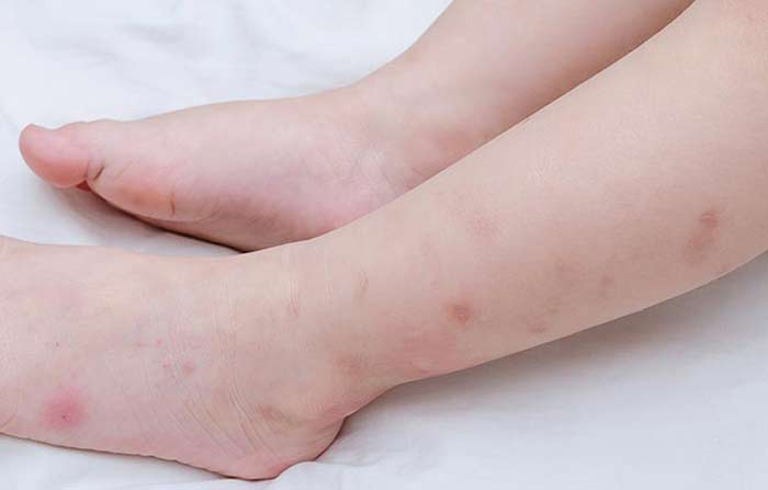 bed bug rash allergy