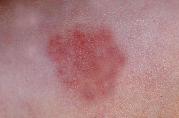 Bed Bug Rash On Skin Pictures Treatment Allergy And Symptoms Pestbugs