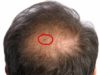 Bed Bugs in Hair Symptoms, Pictures & Get rid Dealing with bed bugs in hair-Symptoms & treatment