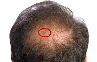 Bed Bugs in Hair Symptoms, Pictures & Get rid Dealing with bed bugs in hair-Symptoms & treatment