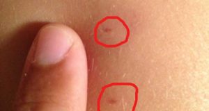 Dust Mite Bites, Pictures, Signs + Ridding Dust mite bite pictures, symptoms and treatment