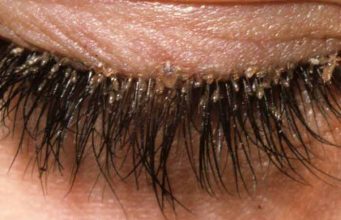 Eyelash(Demodex) Mites-Pictures on Dogs, Human Scalp, Face & How to get Rid How to deal with eyelash mites