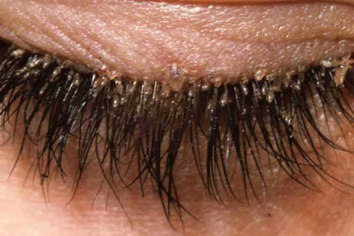 How to deal with eyelash mites