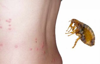 How long do Flea Bites Last? How long do flea bites last and how get rid