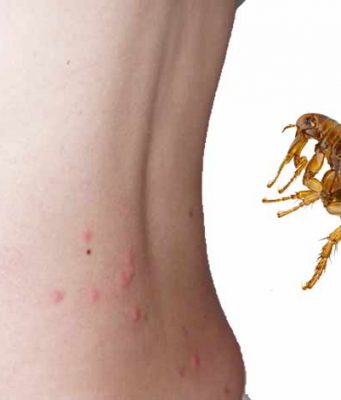 How long do Flea Bites Last? How long do flea bites last and how get rid